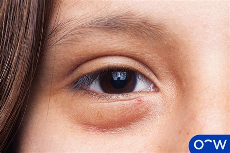 Puffy Eyes: Definition, Causes, Symptoms, and Treatment
