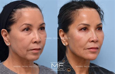 Complete Facial Rejuvenation or Contouring Before and After Pictures