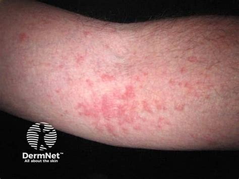 Atopic flexural eczema images