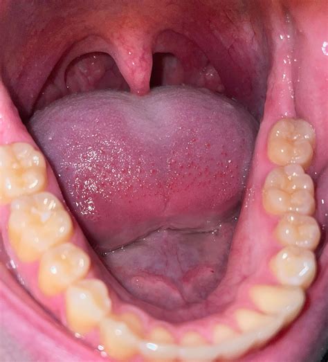 Aside from my fillings and stains do my teeth look bad? : r/Teeth