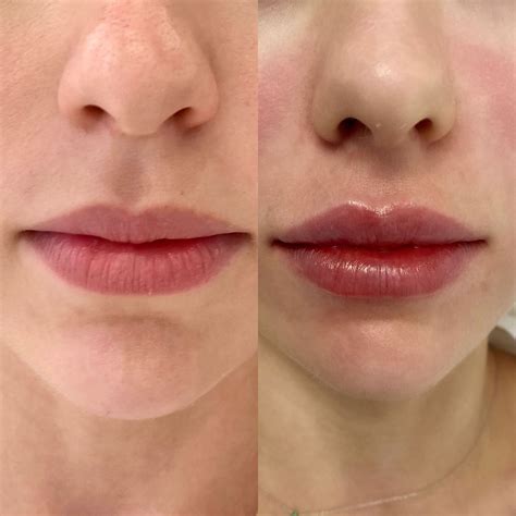 ДО И ПОСЛЕ | ElastoBeauty