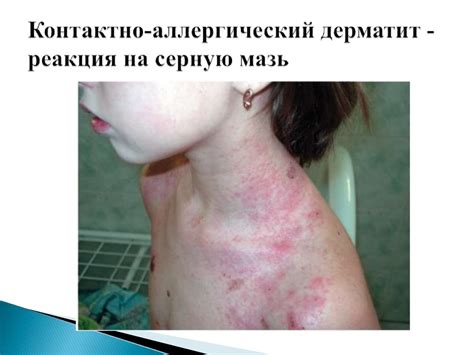 Визуальная диагностика дерматитов. Контактно-аллергический, атопический ...