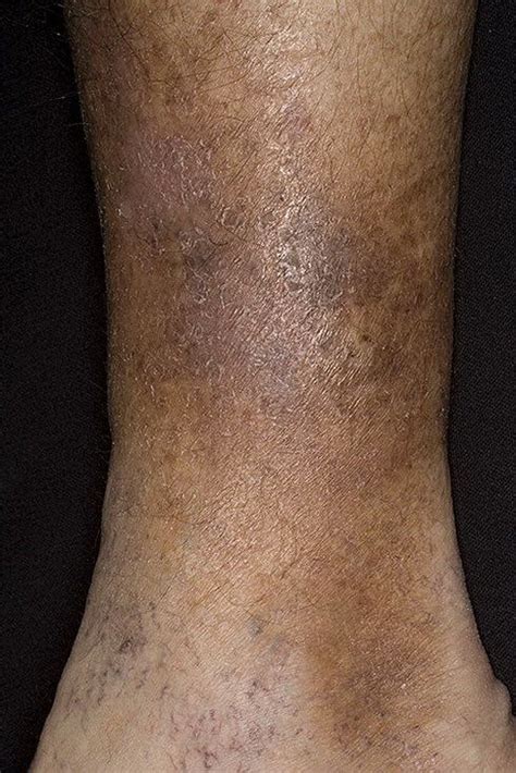 Варикозная экзема фото – 174 шт. / fotodiagnoz.com