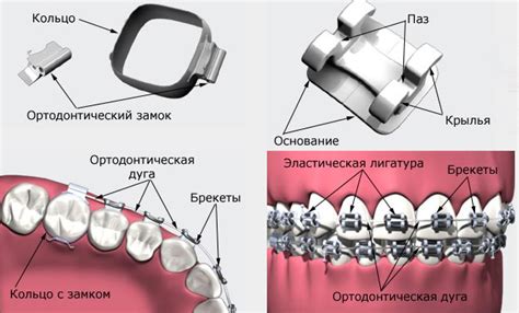 Что такое самолигирующие брекеты? - Дентум Стоматология