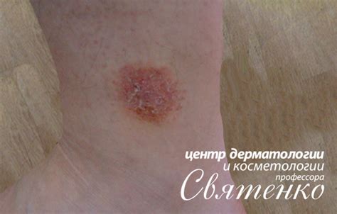 Экземы лечение Днепропетровск Днепр