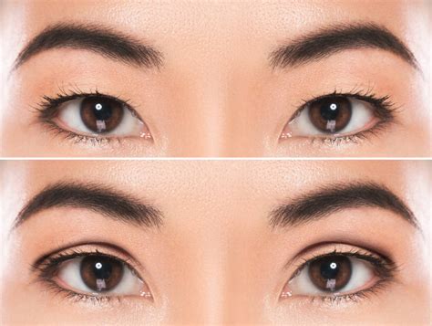 What Are Double Eyelids? - In Focus Ophthalmic Plastic Surgery - Blog