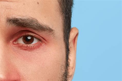 Мейбомит – что это? Причины и симптомы мейбомита | Bausch + Lomb