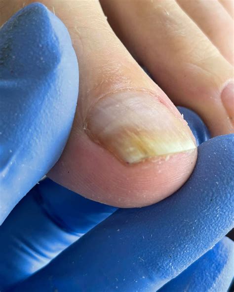 #nails #ingrowntoenail #toenails... - Bagira Nails and Beauty