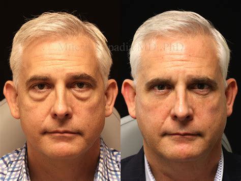 Before and six months after lower blepharoplasty surgery | Boston