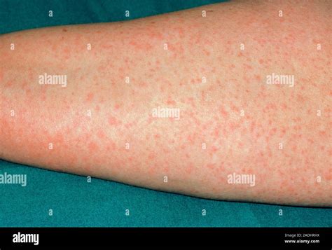 Red rash due to an allergy to penicillin. This is a mild example of ...