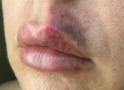 lip filler injections   protocol