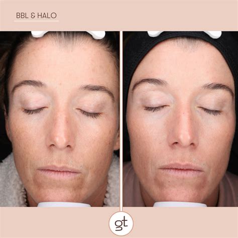 Before and After Gallery Halo Laser - Revolutionary Skin Renewal