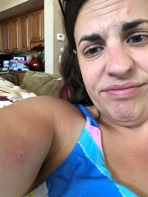 When a yellow jacket sting leads to cellulitis | mostefinitely