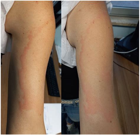 Erythema Migrans Vs Erythema Multiforme