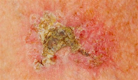 actinic keratosis symptoms actinic keratosis ak  symptoms