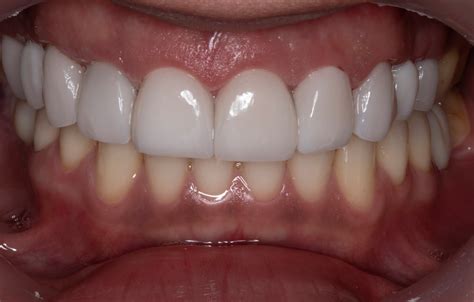 Implantes dentales ️ Restaura tu sonrisa, Medellín