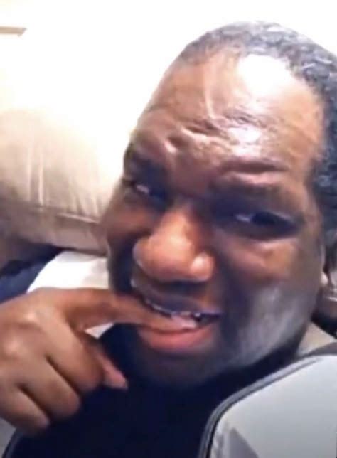 Finger Bite Reaction