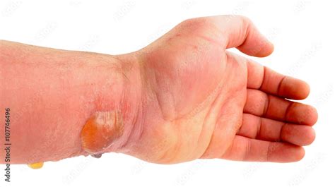 Foto Stock Arm With Blisters Caused By Allergic Reaction To Insect Bite ...
