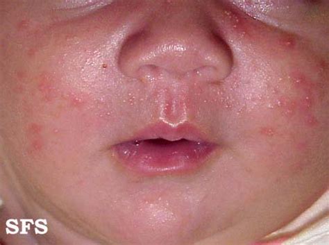 Neonatal acne - wikidoc
