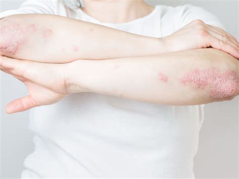 Psoriatic Arthritis: The Basics - Connected Rheumatology