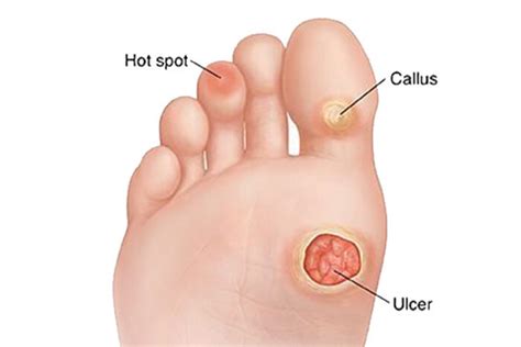 Foot Clinic Santa Ana | DIABETIC FOOT CARE