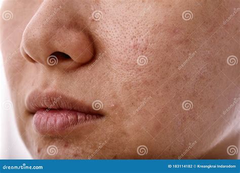 Whitehead Skin