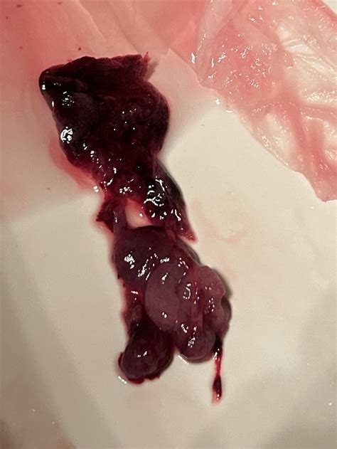 IM ON MY PERIOD. IS THIS MISCARRIAGE OR BLOOD CLOT : r/Periods
