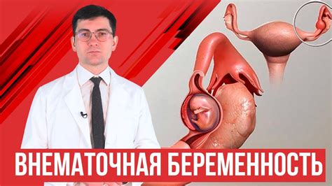 Внематочная беременность. Что делать и какие последствия? - YouTube