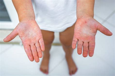 Understanding Dyshidrotic Eczema: A Comprehensive Insight - Bragan Skincare