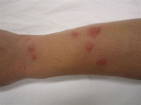 Man's Bug Bite Turned Into A Life-Threatening Flesh-Eating Bacteria ...