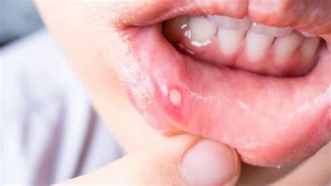 Mouth Blisters Home Remedies: सारखं तोंड येतं? करा हे घरगुती उपाय-mouth blisters home remedies