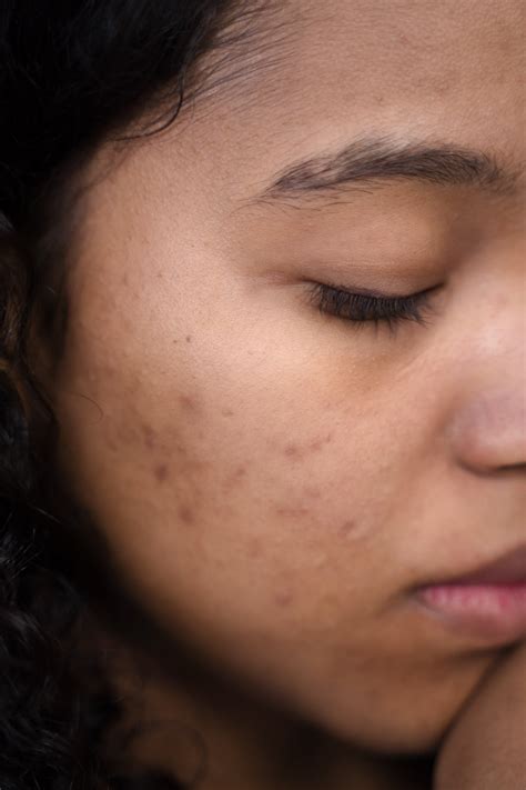 What Are These Bumps On My Face? — Aura Nur Aesthetic