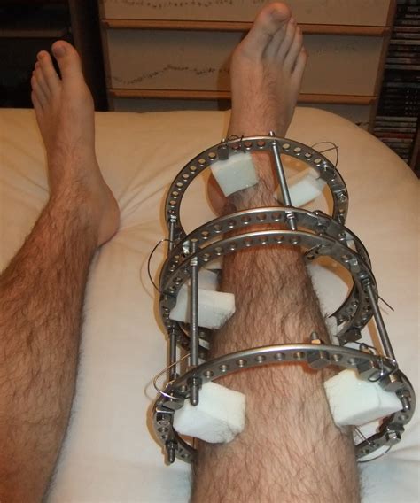 ichi fixator – ﾈｵﾒﾃﾞｨｶﾙ – QBPSBG