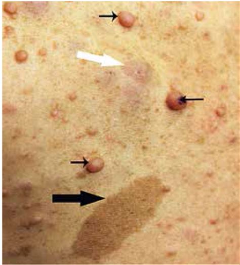Miten tunnistan neurofibromatoosin?