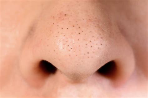 blackheads  face