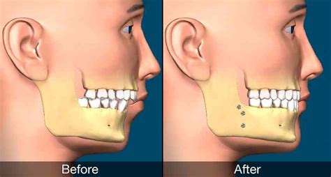 Jaw Straightening Surgery Options - Ascent Family Dental