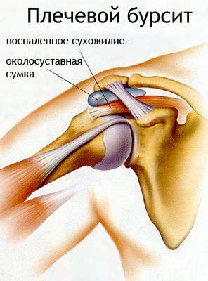 Лечение бурсита локтевого и коленного суставов | Med & Care