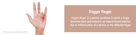 Trigger Finger | Stenosing Tenosynovitis