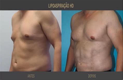 Qual O Valor De Uma Lipo Na Barriga - Lipo Lad, HD, 3D, Alta Definição: Fotos, Valor, Antes E Depois e O Que ...