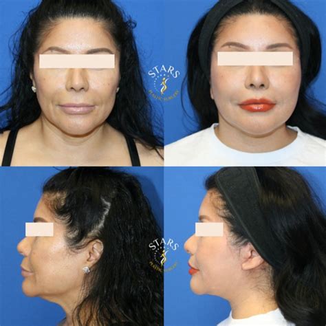face lift  neck lift expert san antonio tx advice