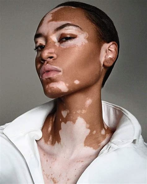 Vitiligo: What Is It And How Can I Get Rid Of It? - Shoreshim