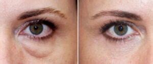 Dermaheal Eyebag Solution x 1.5ml vial