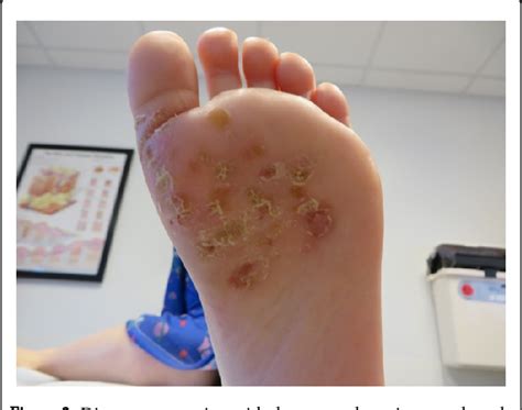 Tinea Pedis Vesicular