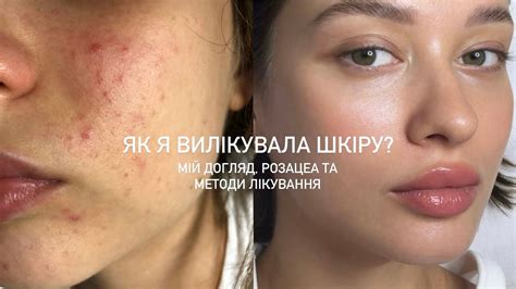 Як я вилікувала шкіру? Мій догляд, розацеа та методи лікування - YouTube