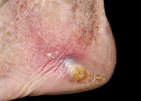 skin disease  metabolic syndrome early warning signs   greater