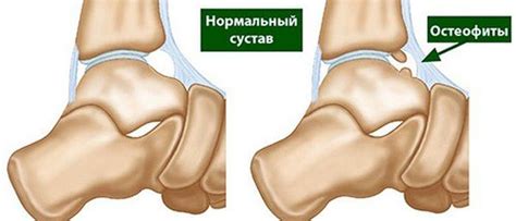 Остеофиты коленного сустава: лечение, профилактика
