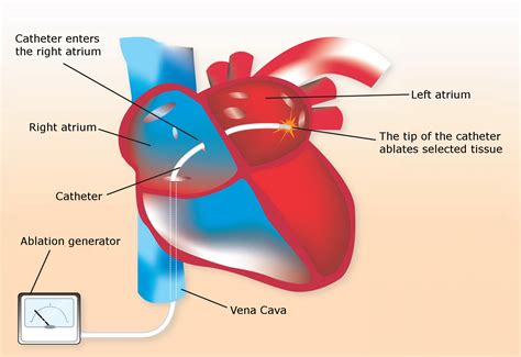 Accentuating Cardiac Ablation - Business Listing Blog 