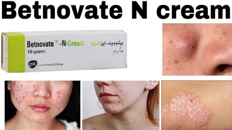 betnovate  skin care cream    benefits side effects youtube