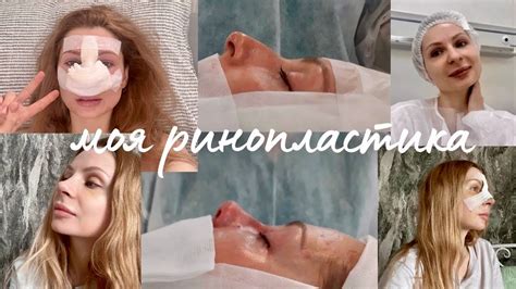 МОЯ РИНОПЛАСТИКА 💜 Ринопластика в Минске 💜 ДО и ПОСЛЕ - YouTube