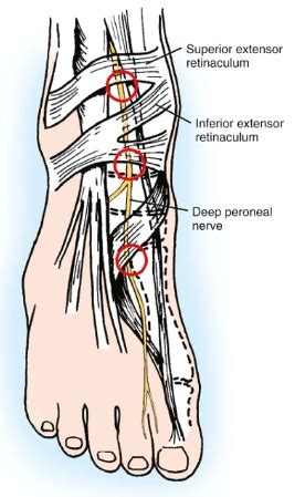 Deep Peroneal Nerve Entrapment - Foot & Ankle - Orthobullets